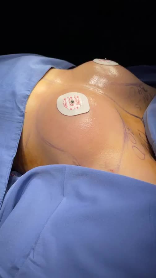 Ca phẫu thuật nâng ngực của chị khách hàng U40.