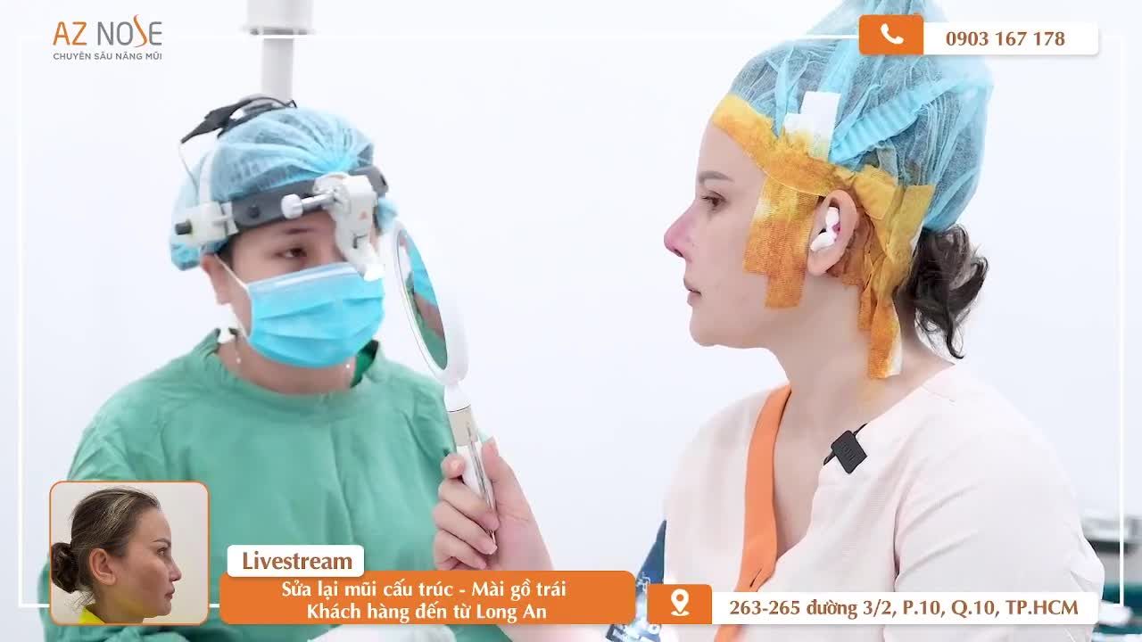 Khắc phục mũi l.ệch - da m.ỏng cho khách hàng 8X đến từ Long An