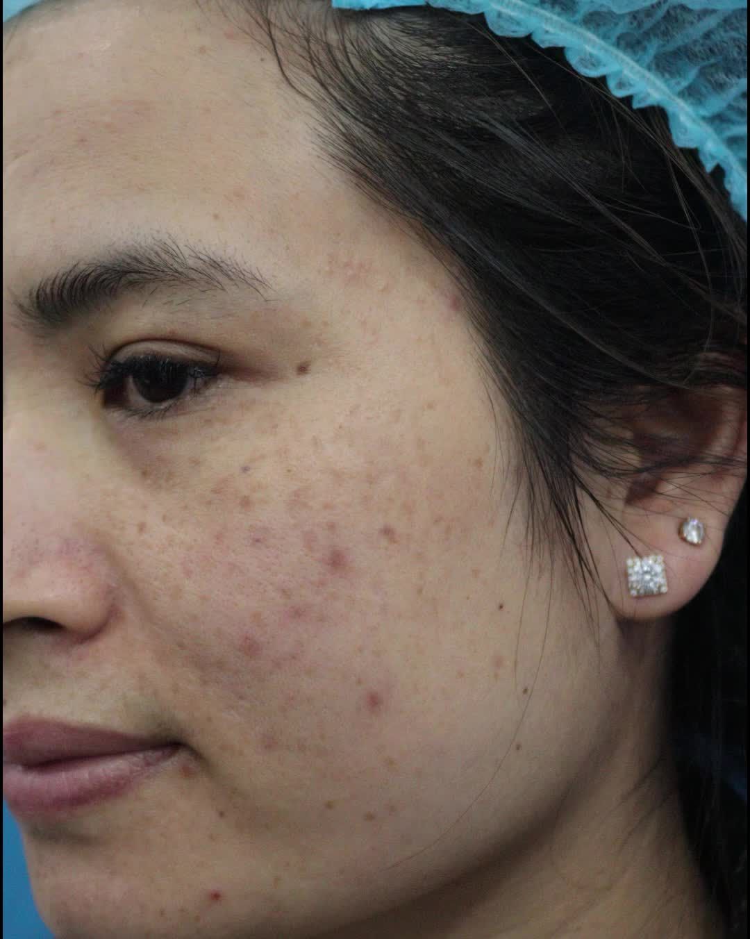 Trị nám buổi thứ 3 với Laser Picosure