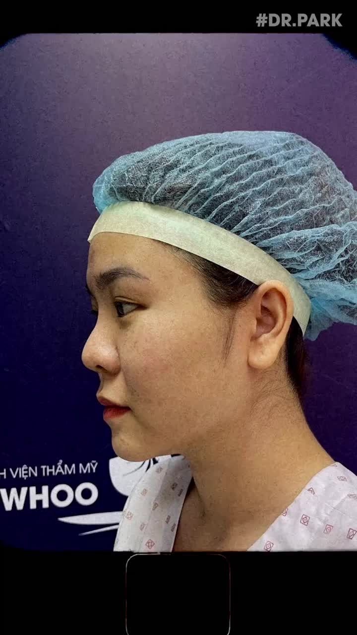 THỰC HIỆN NÂNG MŨI - BẤM MÍ 1 LÚC SẼ THAY ĐỔI BẠN NHƯ THẾ NÀO?