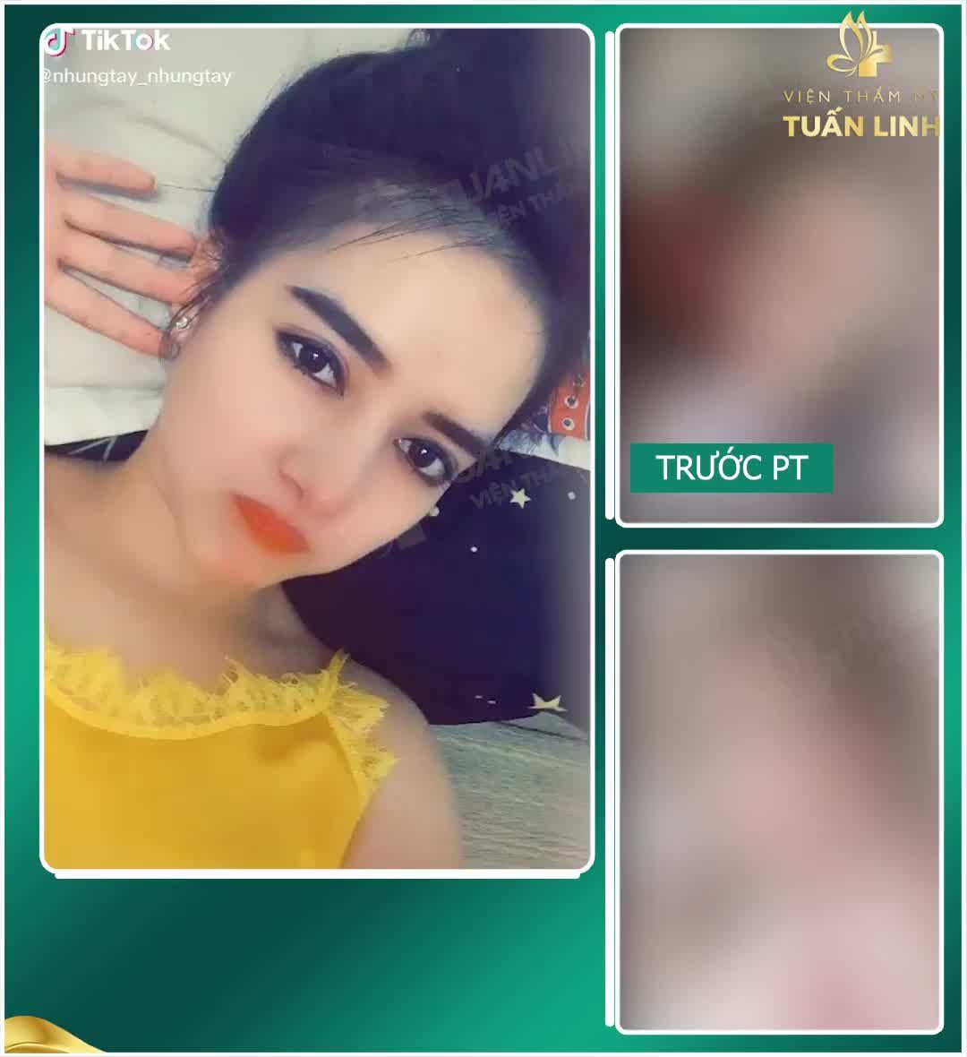 NÂNG MŨI CAO SANG TÀI LỘC NGÚT NGÀN