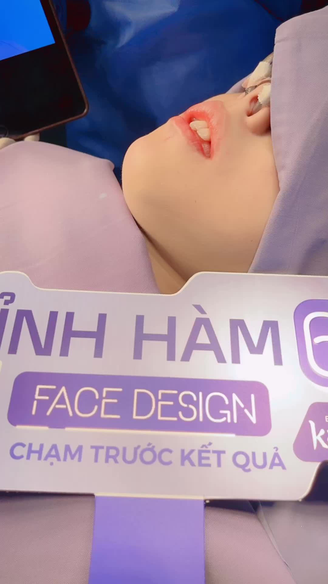 Giải cứu THÀNH CÔNG ca mặt lệch cực khó với công nghệ Chỉnh Hàm 6D tại Kangnam Sài Gòn ngay lúc này