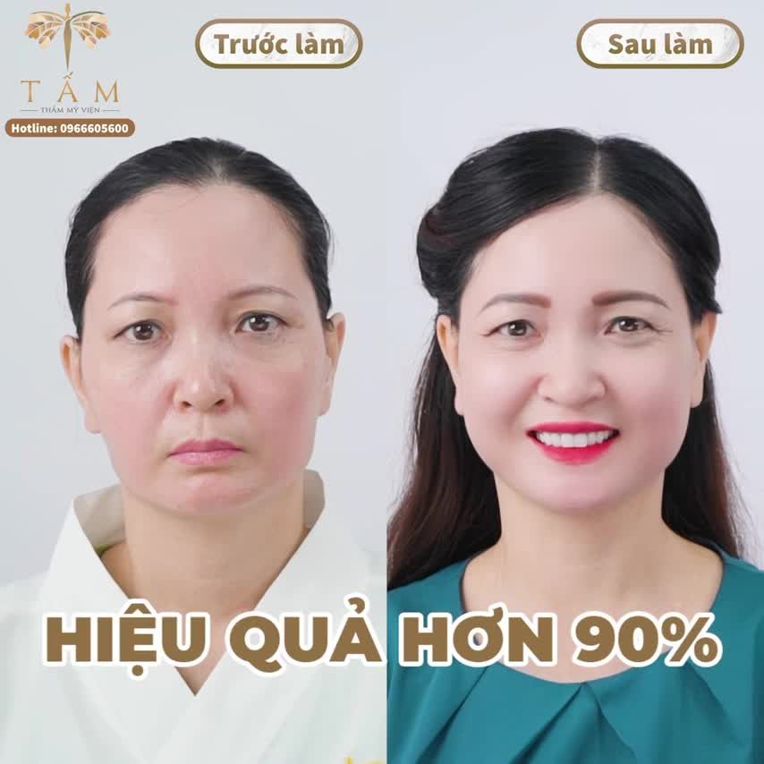 Combo Filler đánh thức vẻ đẹp - giữ trọn nét xuân