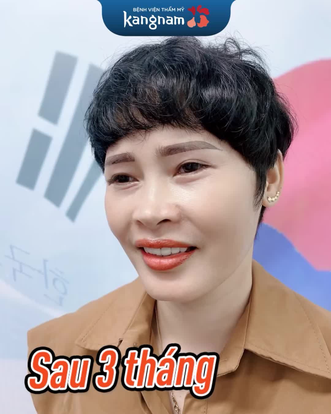 Sang chảnh mấy "chân kính" cho chị khách hàng Chỉnh hô 2 hàm kết hợp hạ gò má, trượt cằm