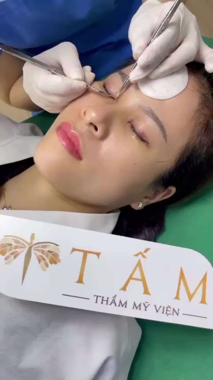 Khách hàng quay lại tái khám sau 6 ngày làm Combo Mở góc mắt trong + Mở góc mắt ngoài và hạ xếch tại TMV Tấm. Tình trạng tím/sưng được cải thiện đáng kể.