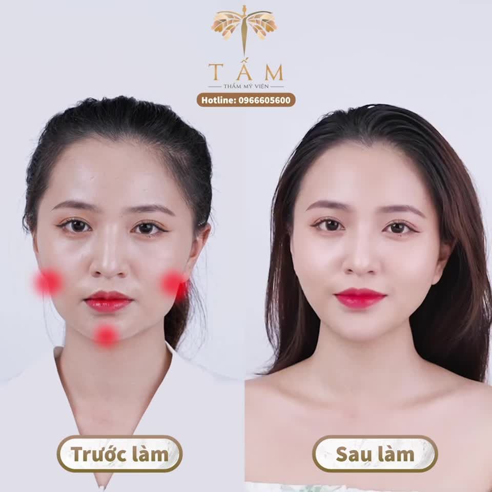 Làm đẹp nhẹ nhàng, tạo đường nét hài hoà, tự nhiên cùng Combo Filler má, cằm