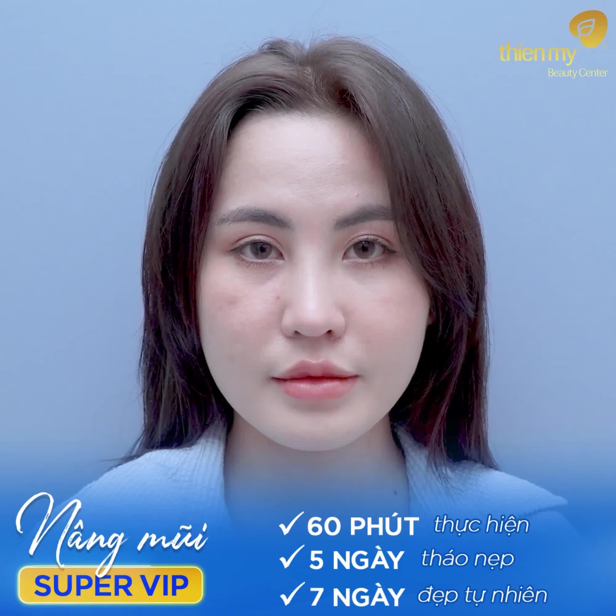 FEEDBACK NÂNG MŨI SUPER VIP KẾT QUẢ NHƯ MONG MUỐN SAU 7 NGÀY