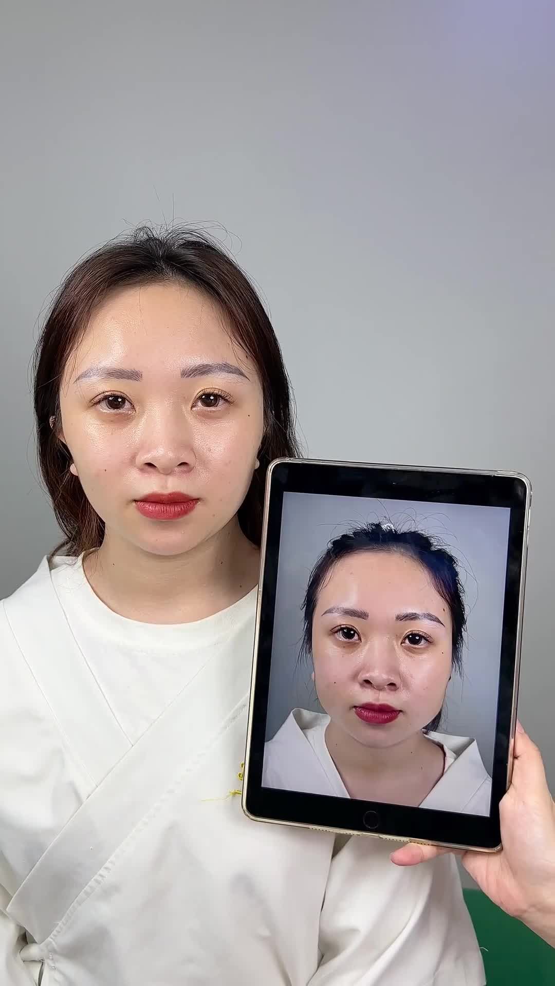 Ca thon gọn hàm Vline Perfect quay lại tái khám tại TMV Tấm