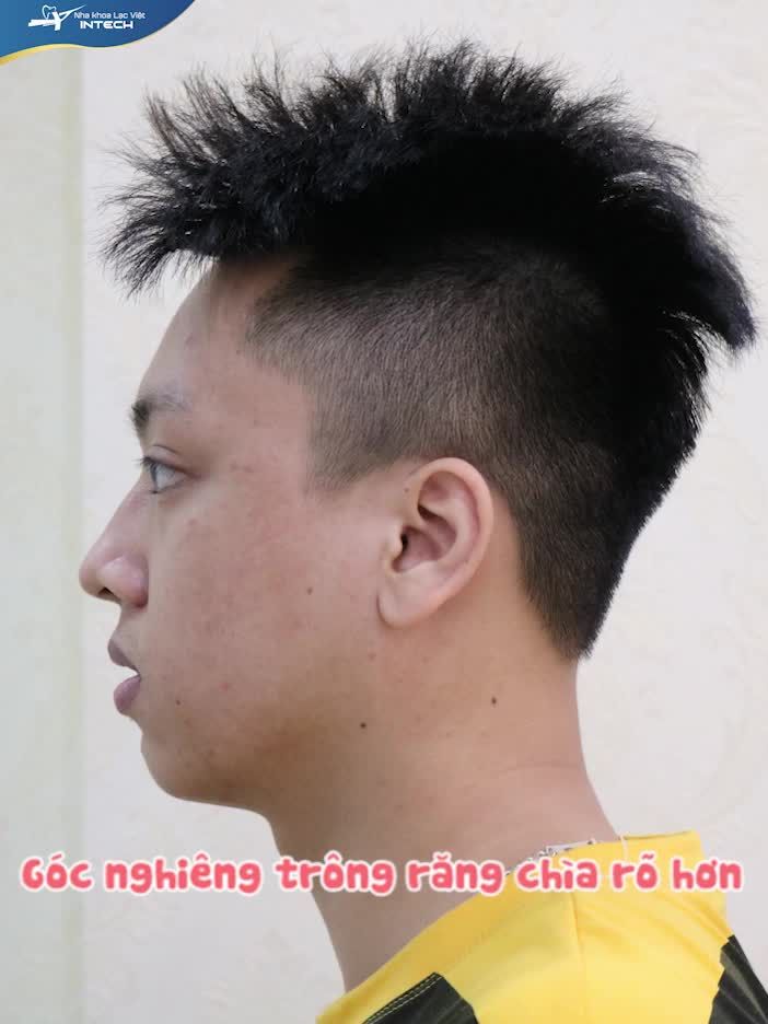 LỘT XÁC THÀNH HOTBOY NHỜ NIỀNG RĂNG