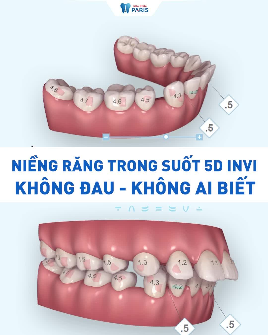 Khay niềng cá nhân hóa