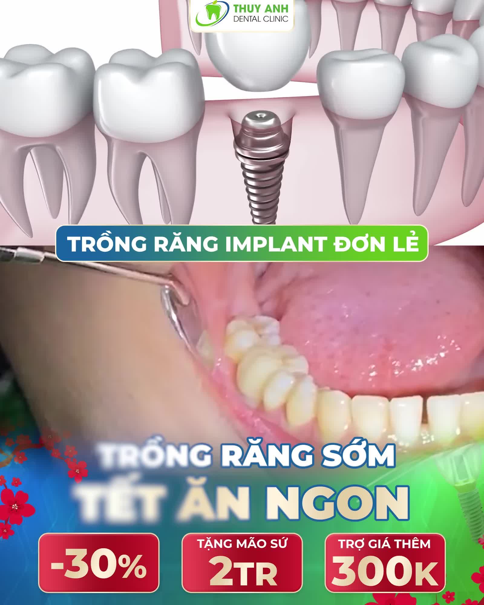 TRỒNG RĂNG SỚM TẾT ĂN NGON