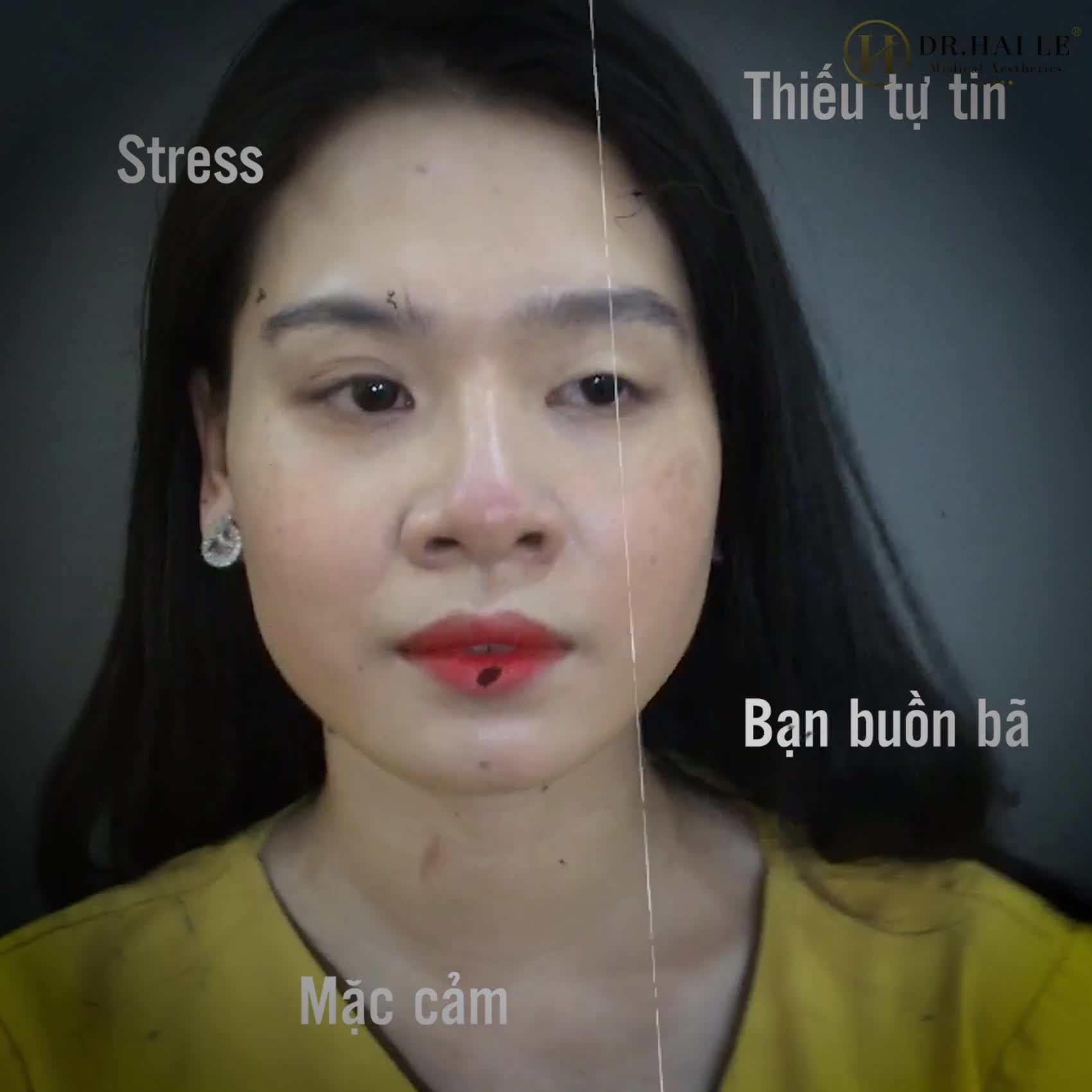 Ấn tượng của khách hàng sau khi trải nghiệm dịch vụ cắt mí, sửa mí tại Dr.Hải Lê