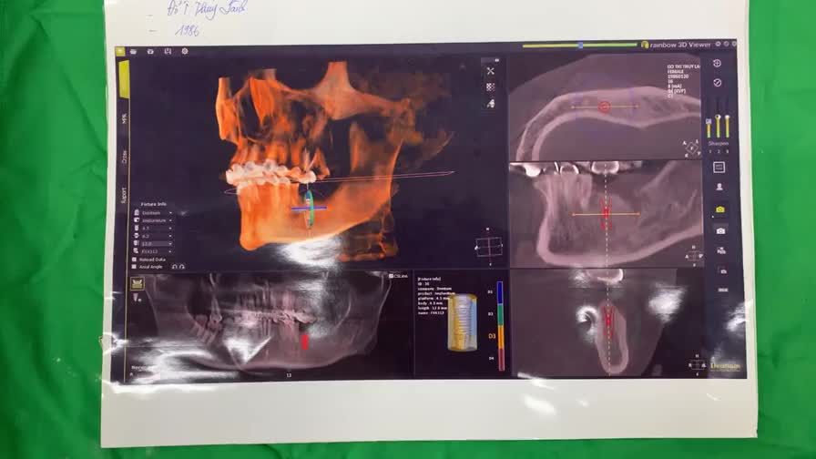 Lắp răng implant khôi phục răng 36 bị mất cho chị khách hàng tại Nha Khoa Thuỳ Anh.