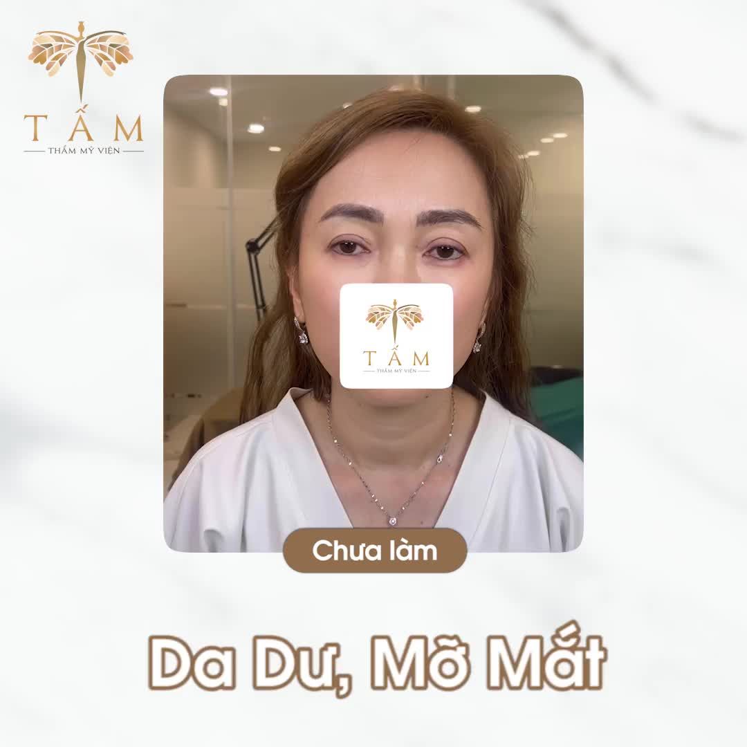 Trẻ hoá đôi mắt trở nên rạng rỡ hơn với Combo Nâng cung chân mày + Bóc mỡ đầu mắt tại Tấm!