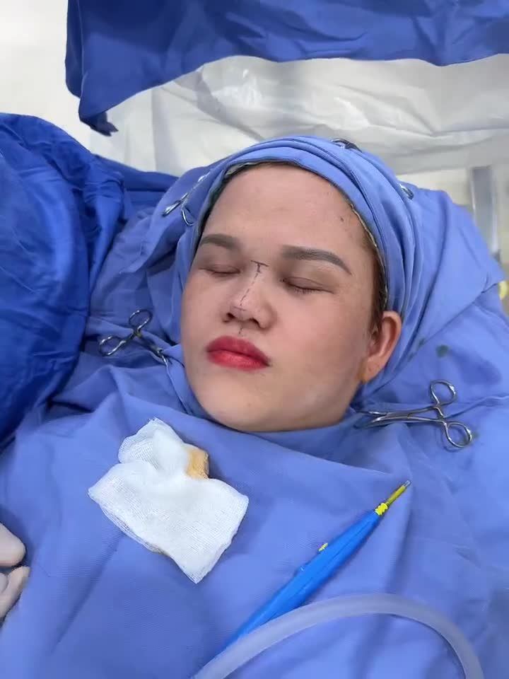 Nâng mũi đón Tết, đón Tài Lộc!