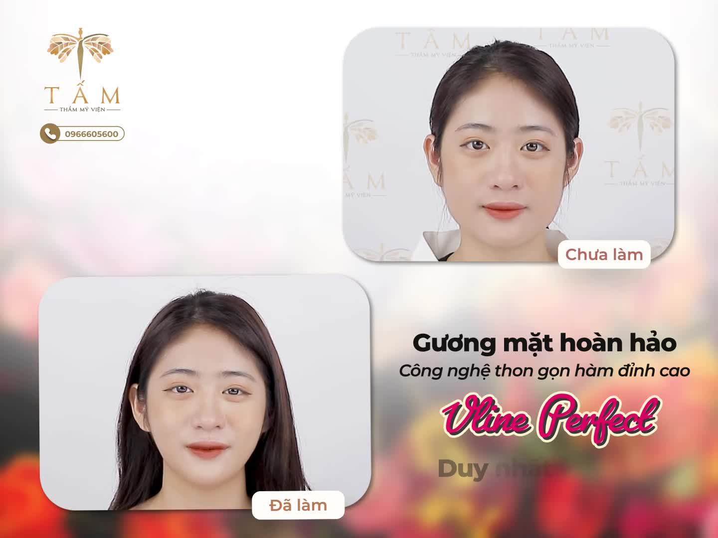 Chúc Linh chia sẻ: "Làm xong gọn hàm Vline em công nhận mặt nhỏ hẳn, bạn bè hay gia đình đều khen là xinh hơn. Đáng lẽ em nên đi làm từ lâu rồi".