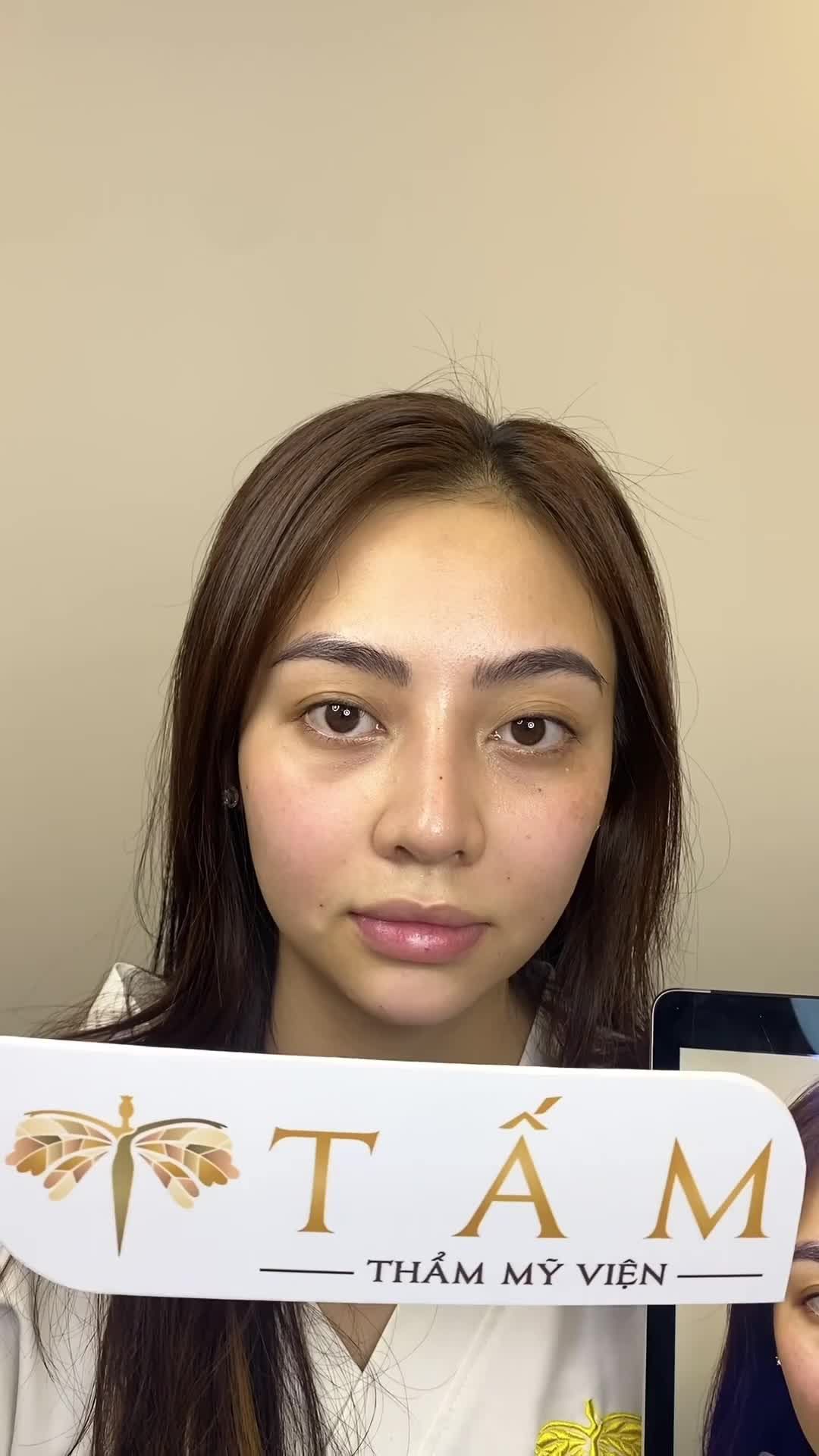 Ca cân chỉnh dáng cằm nhờ Filler tại Tấm. Mọi người cùng theo dõi để thấy sự thay đổi hài hoà trên gương mặt của bạn khách nhé
