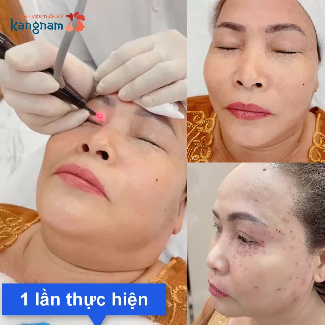 Tết đến nơi rồi đi bắn mụn thịt thôi