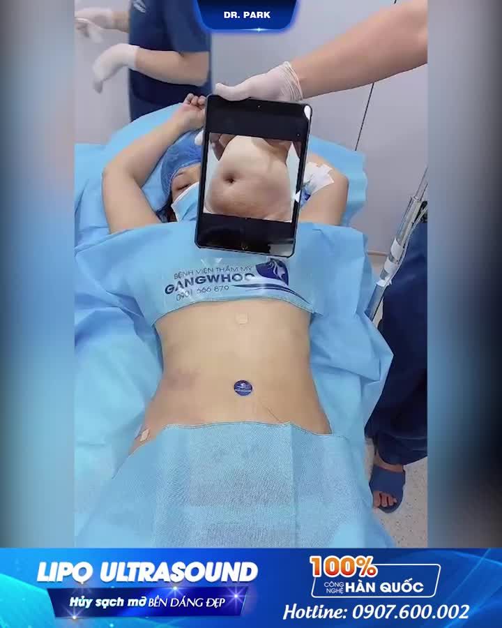 LIPO ULTRASOUD - VÓC DÁNG THON GỌN VỚI 60 PHÚT