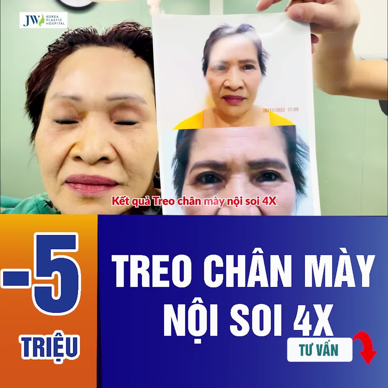TREO CHÂN MÀY NỘI SOI 4X – ĐÁNH BAY NỖI LO TUỔI TÁC