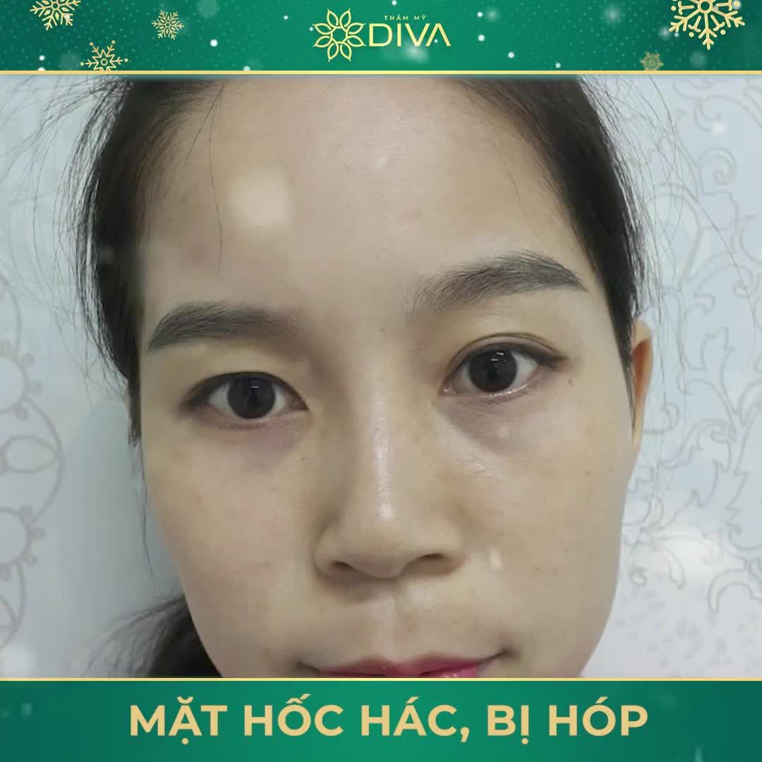 6 LÝ DO BẠN NÊN CẤY MỠ COLEMAN LÀ GÌ ?