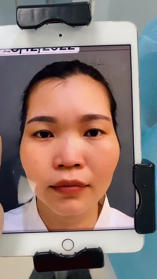 Dáng mũi cấu trúc vừa xong