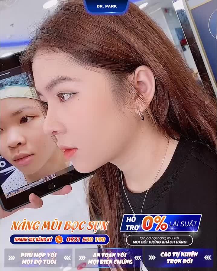 NÂNG MŨI BỌC SỤN – KHẮC TINH MŨI BÓNG ĐỎ LỘ SÓNG