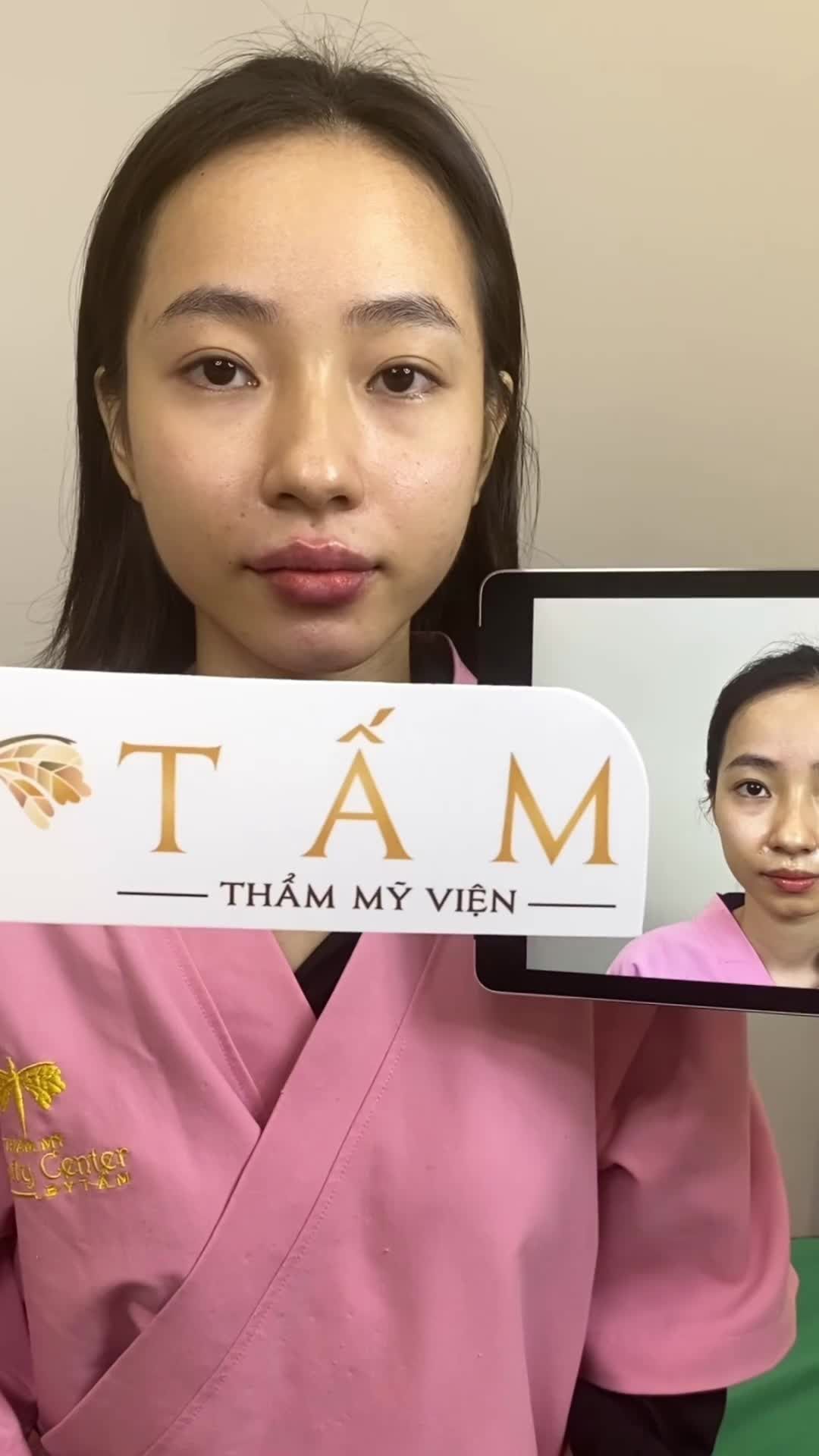 ca combo 8cc filler cân chỉnh thái dương, má, cằm, môi, rãnh cười.