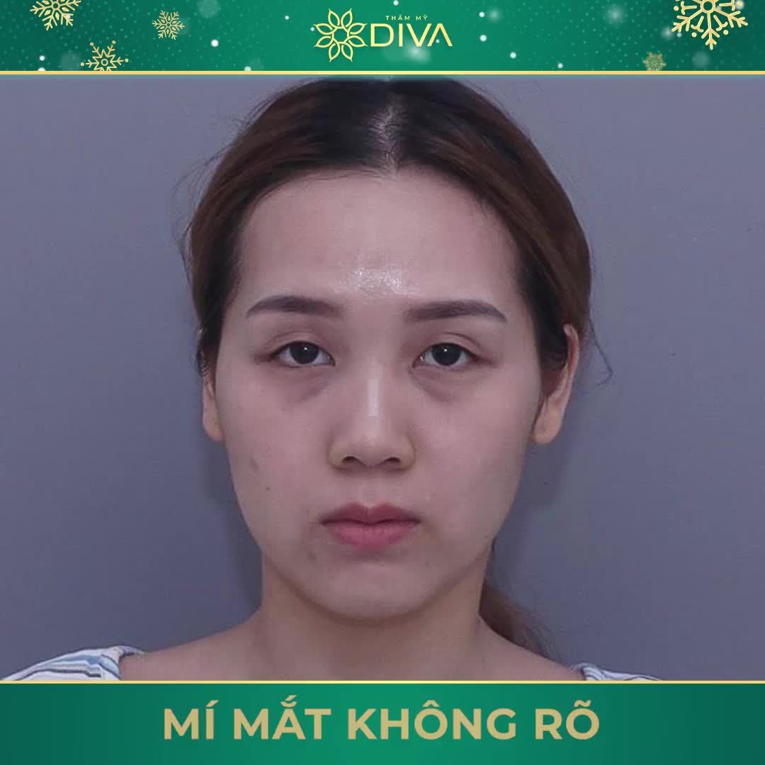 VÙNG MẮT GẶP TÌNH TRẠNG NÀO THÌ NÊN ĐI THẨM MỸ?