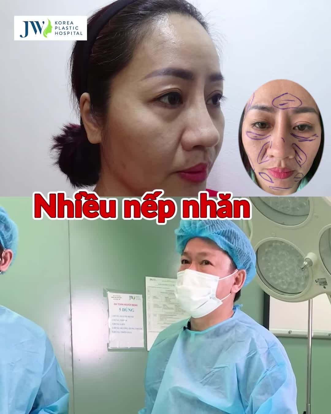 CẤY MỠ MẶT - GƯƠNG MẶT ĐẦY ĐẶN - TRẺ HẲN 20 TUỔI