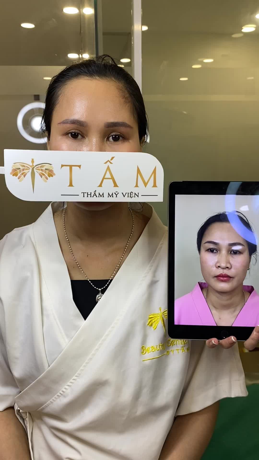 khách hàng tái khám mắt sau 1 tháng thực hiện dịch vụ nâng cung chân mày tại TMV Tấm. Kết quả làm chị khách rất hài lòng về khuôn mắt hiện tại.