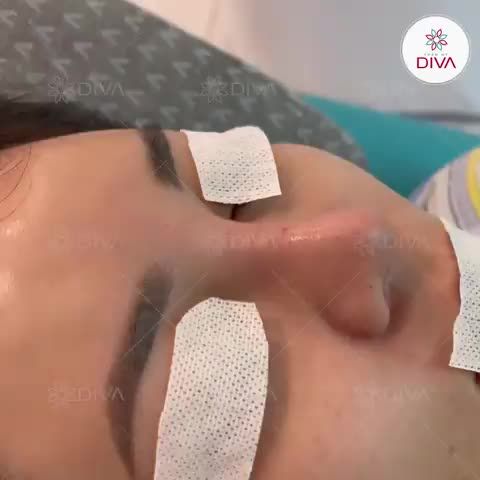 15 PHÚT NÂNG MŨI TINY POINT: DÁNG MŨI THANH THOÁT, HÀI HÒA