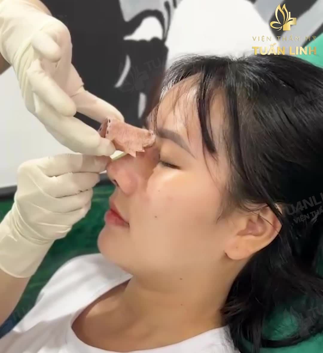 Cận cảnh chiếc mũi cấu trúc kết hợp bọc Megaderm toàn sống sau 10 ngày tái khám, tháo nẹp.