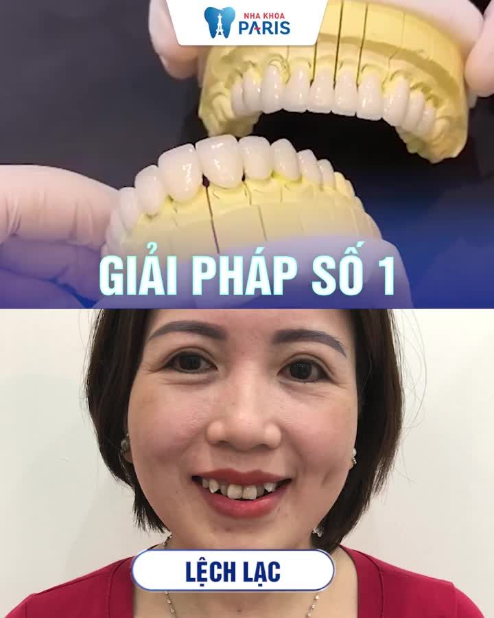 Tạm biệt răng xấu Xỉn màu Vận Xui