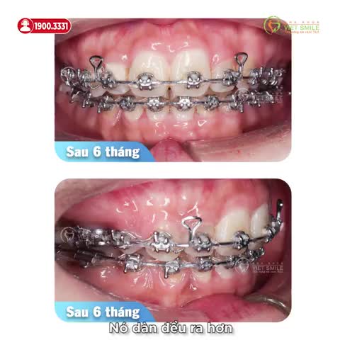 THÁO NIỀNG RĂNG KHẤP KHẾNH LẤY LẠI NỤ CƯỜI TỰ TIN
