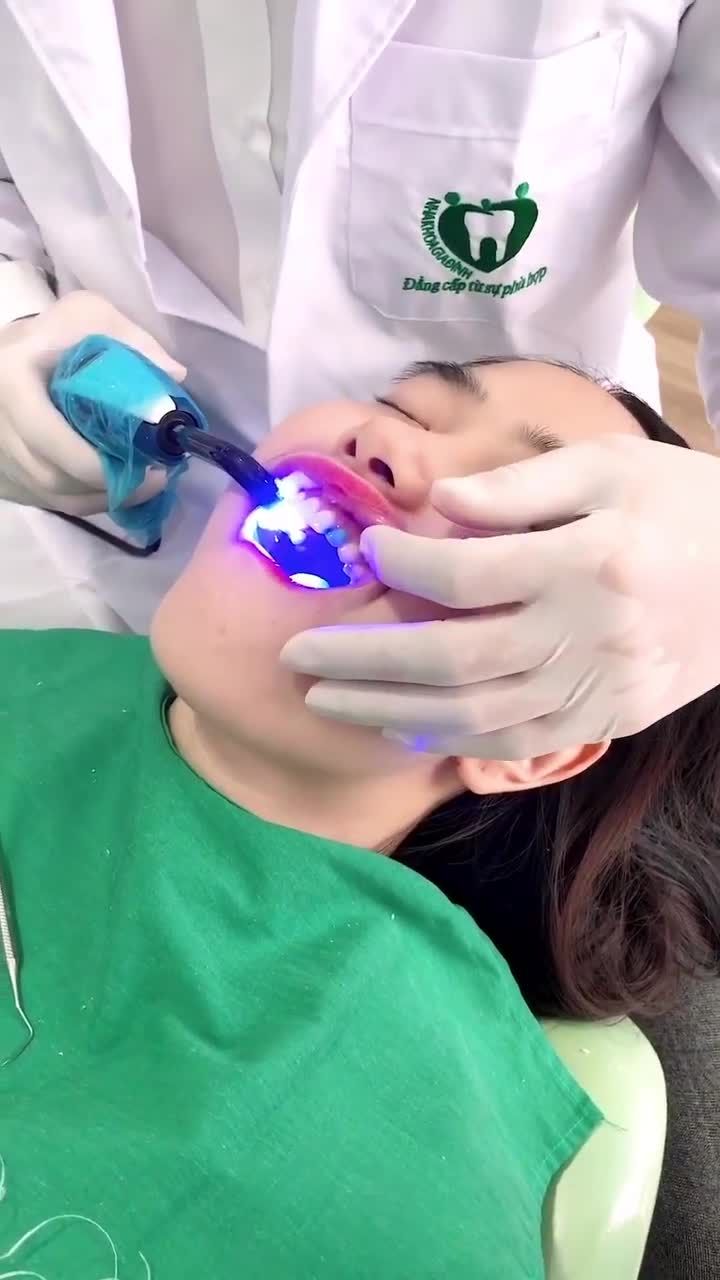 KHÁCH HÀNG CHỌN DÁN SỨ VENEER TẠI NHA KHOA GIA ĐÌNH