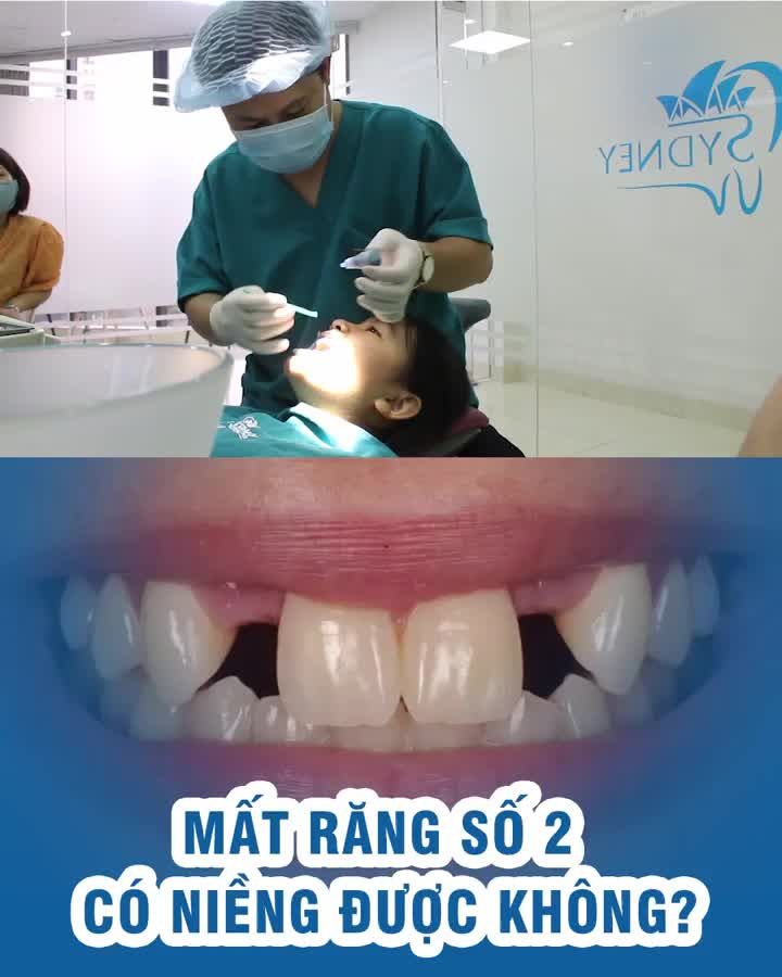 Mất răng số 2 có niềng được không?