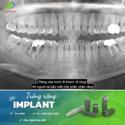 TRỒNG RĂNG IMPLANT - HỎNG RĂNG NÀO TA SỬA RĂNG ĐÓ