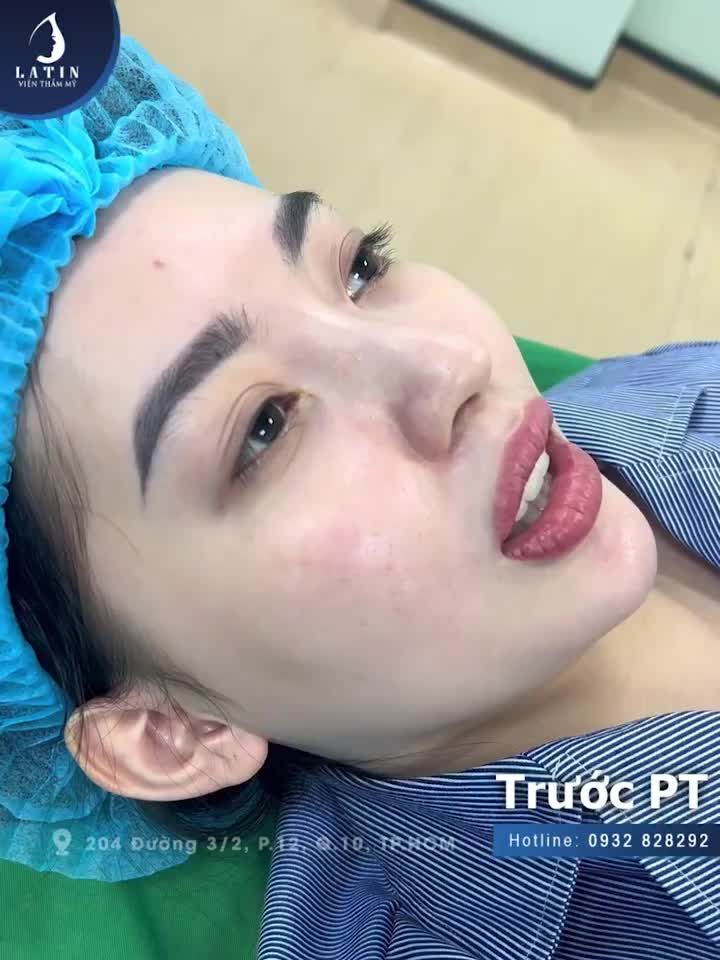 Bạn khách hàng đã sở hữu dáng mũi ưa nhìn tự nhiên nhưng gồ nhẹ khiến cuộc sống của bạn có nhiều điều không như ý.