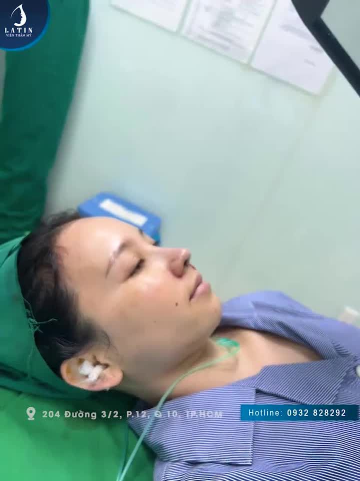 Hoàn thành ca nâng mũi cấu trúc cho khách hàng Latin Mũi cấu trúc, thu nền mũi, thu cánh mũi