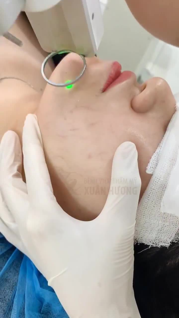 CẬN CẢNH QUÁ TRÌNH TRỊ GIÃN MAO MẠCH TẠI XUÂN HƯƠNG, HIỆU QUẢ TỚI 90% NGAY SAU KHI THỰC HIỆN
