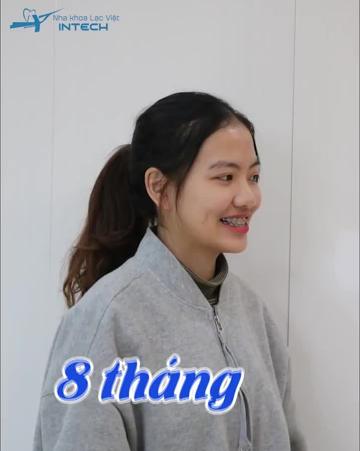 NẾU BIẾT TRƯỚC THÌ MÌNH ĐÃ ĐI NIỀNG RĂNG SỚM HƠN…