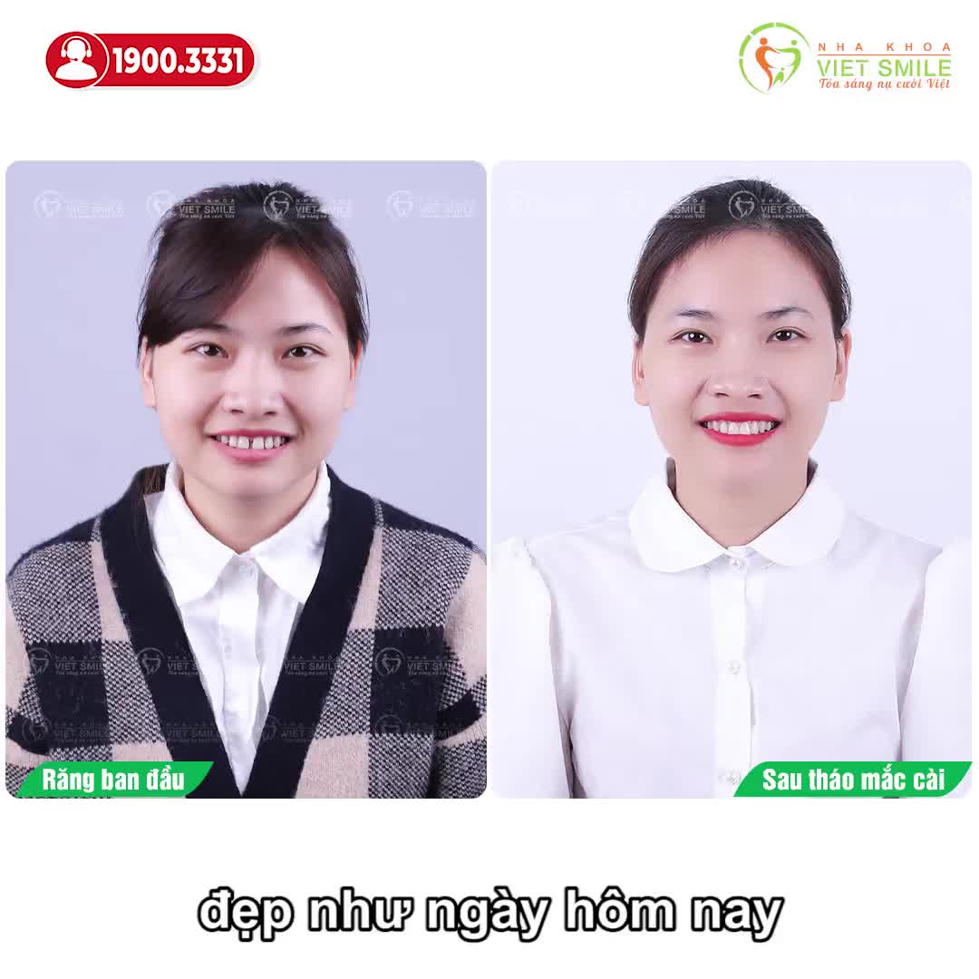 THÁNG NIỀNG RĂNG THƯA SAU 1,5 NĂM