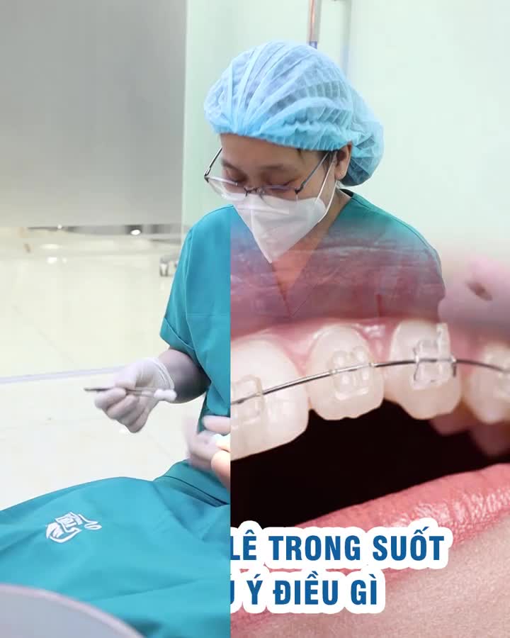 Niềng pha lê trong suốt cần chú ý điều gì?
