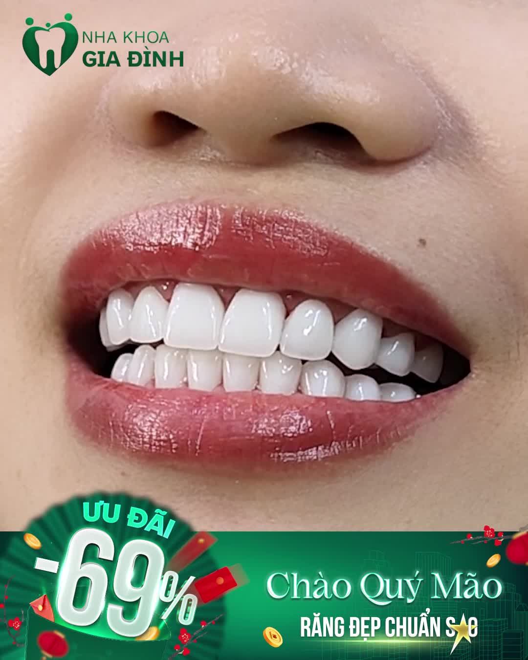 XÓA TAN NỖI ÁM ẢNH RĂNG XẤU VỚI THẨM MỸ RĂNG SỨ TẠI