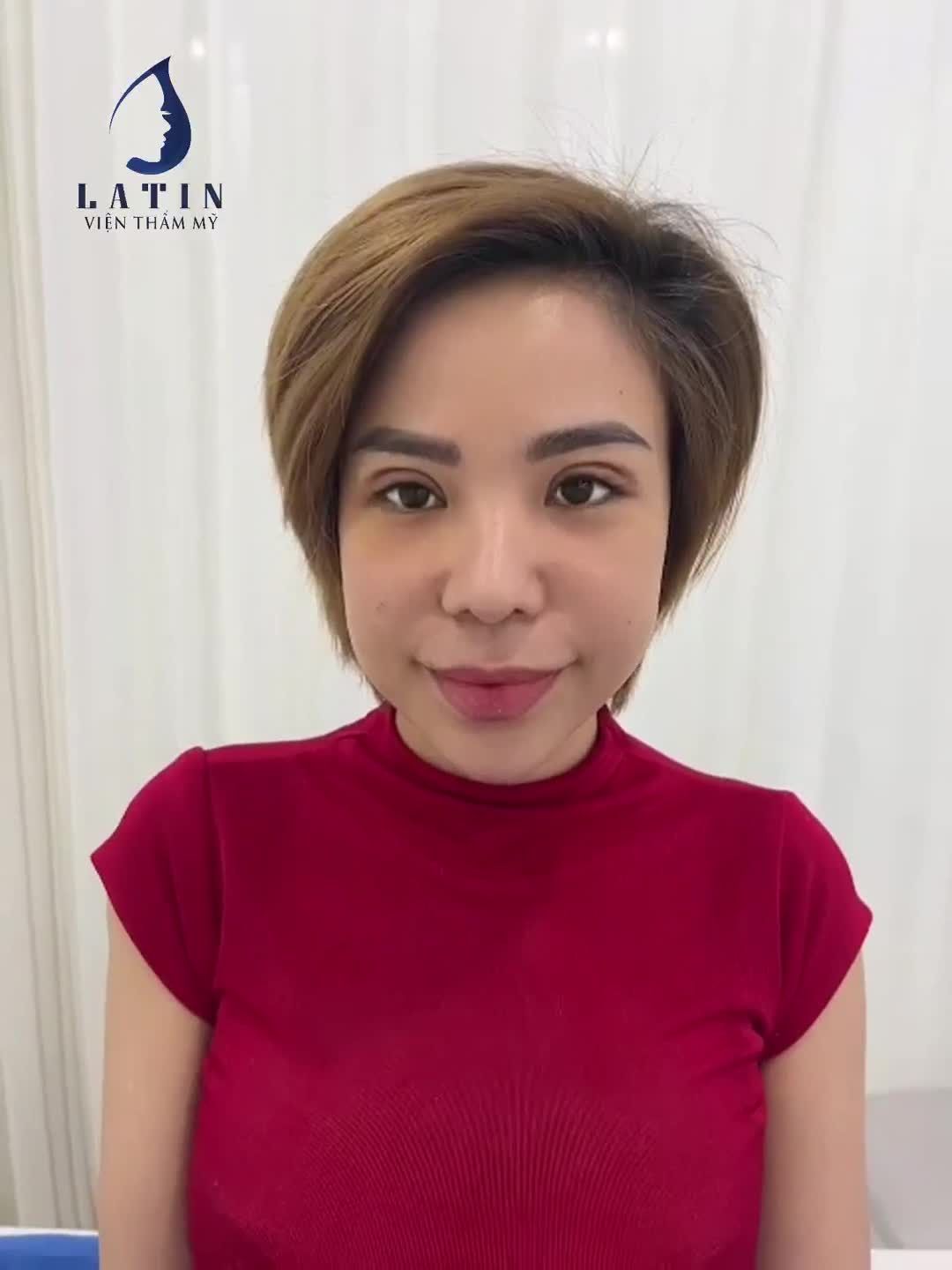 hình ảnh khách nhà Latin tái khám sau 7 ngày cắt mí 4D