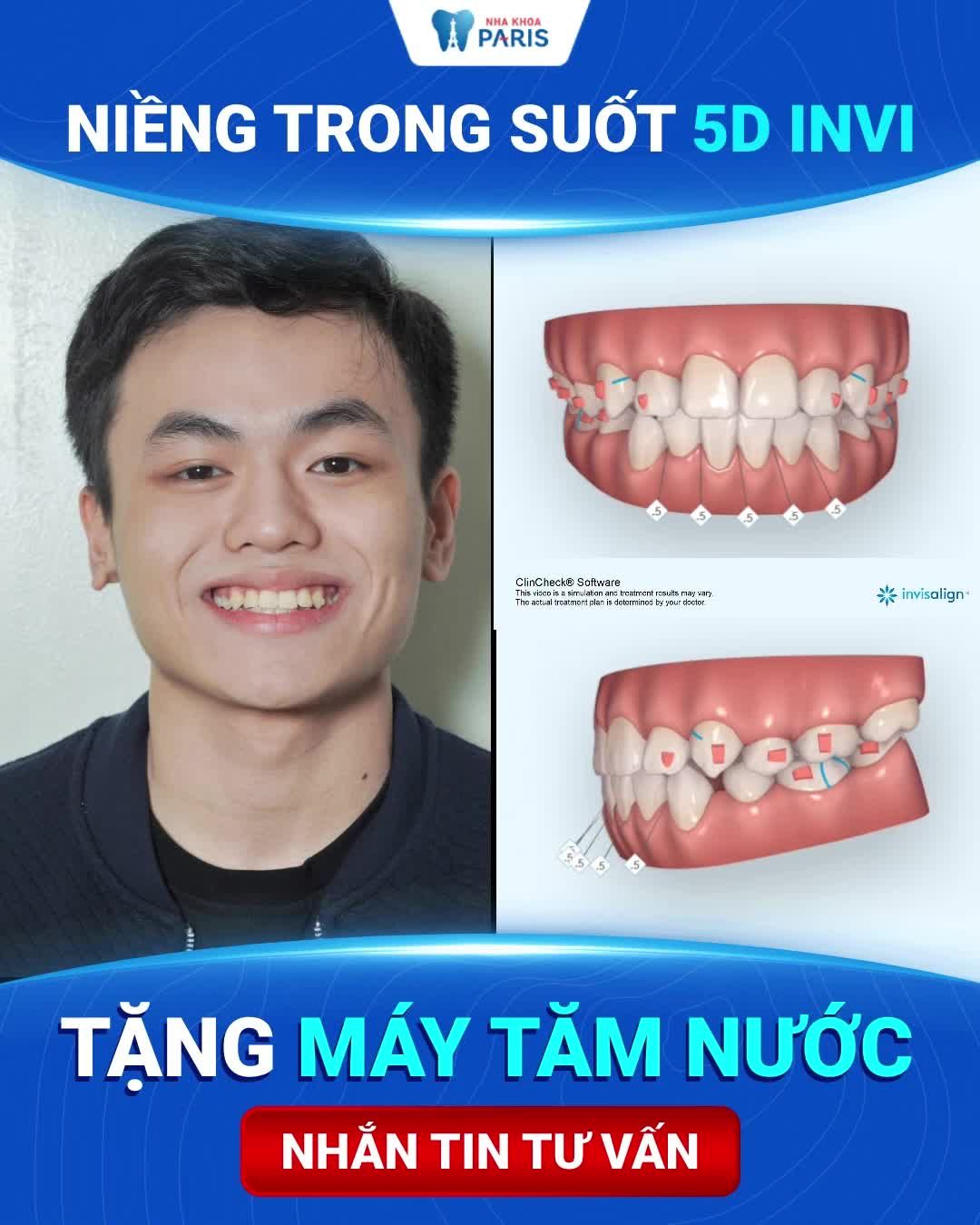 Hết lo lắng răng chạy lại sau niềng