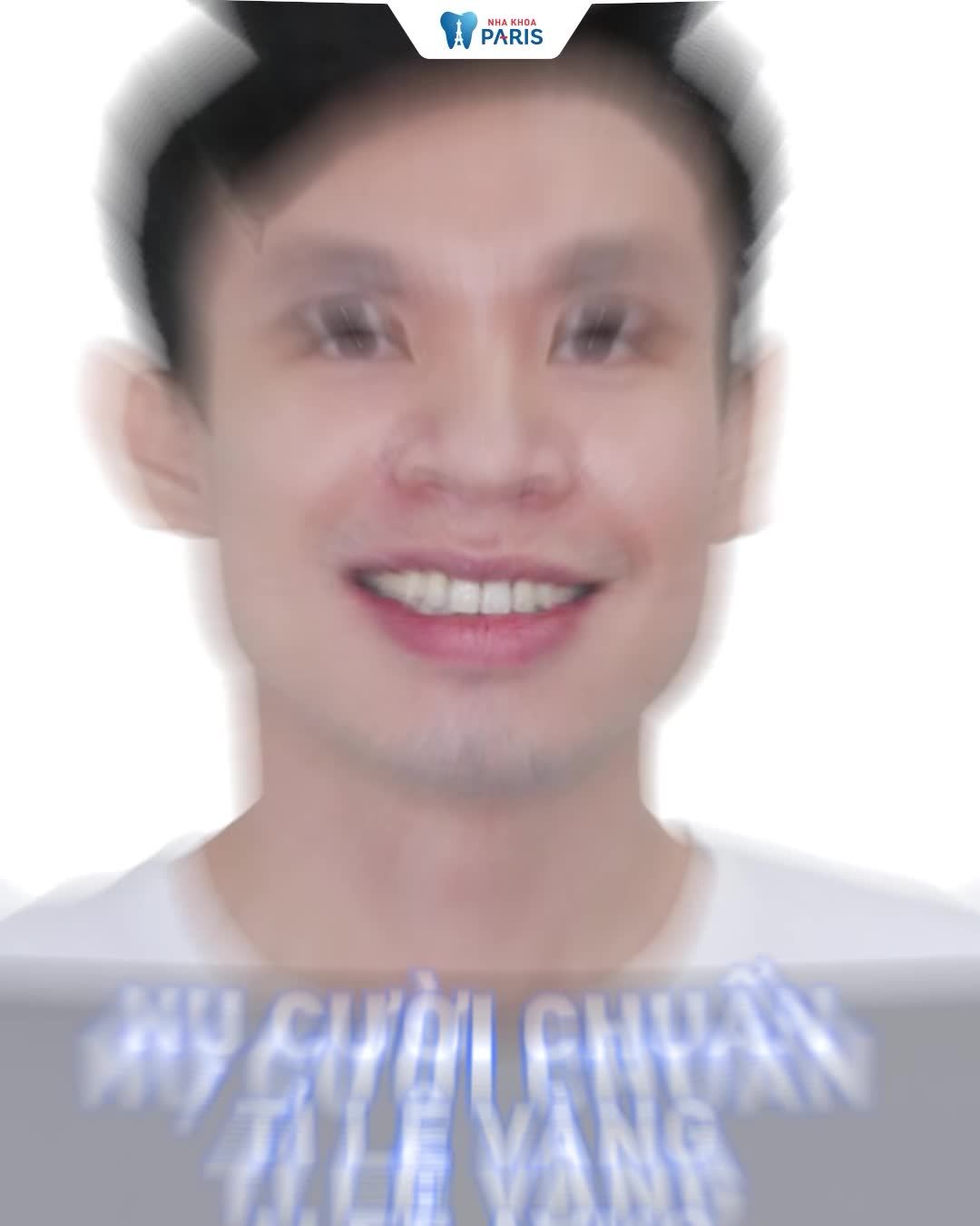NIỀNG RĂNG KHÔNG ĐAU - KHÔNG AI BIẾT