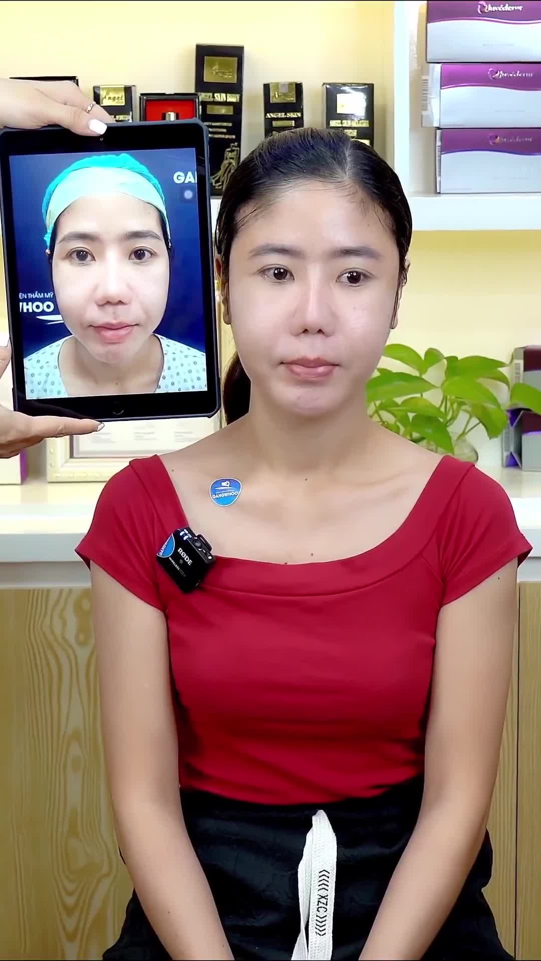 CHỊ KHÁCH HÀNG CẢI THIỆN GƯƠNG MẶT HỐC HÁC - HÓP PHẦN THÁI DƯƠNG SAU KHI ĐỘN THÁI DƯƠNG NANO