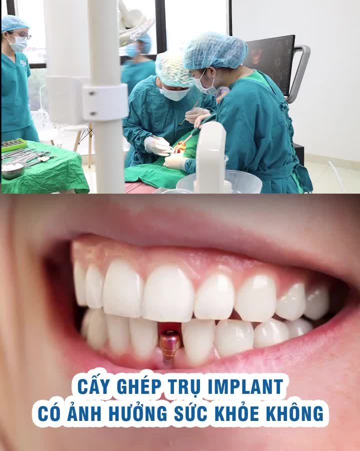 Cấy ghép trụ Implant có ảnh hưởng sức khỏe không?